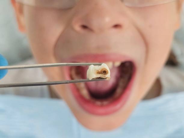 Best Same-Day Emergency Dentist in Piednt, MO